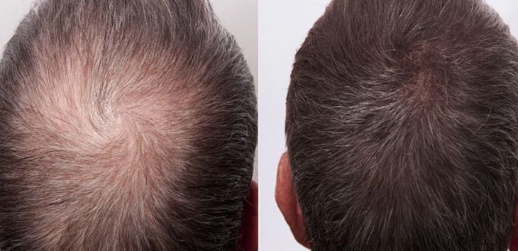 Before &After